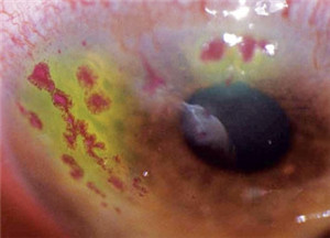 眼表眼角膜,希瑪瑞視眼科,上海眼科醫(yī)院