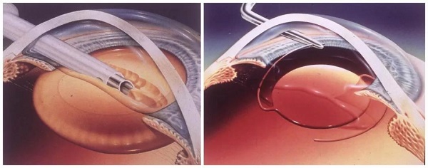 白內(nèi)障,?，斎鹨曆劭?上海眼科醫(yī)院