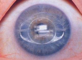 屈光矯視,?，斎鹨曆劭?上海眼科醫(yī)院