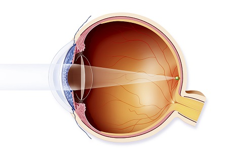 白內(nèi)障,?，斎鹨曆劭?上海眼科醫(yī)院