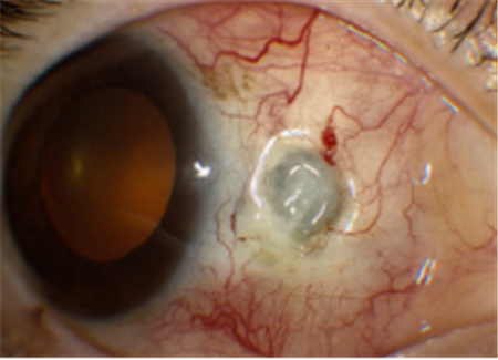 眼表眼角膜,希瑪瑞視眼科,上海眼科醫(yī)院