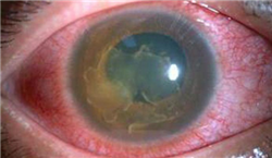 眼表眼角膜,?，斎鹨曆劭?上海眼科醫(yī)院