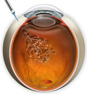 玻璃體視網(wǎng)膜,?，斎鹨曆劭?上海眼科醫(yī)院