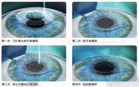 屈光矯視,?，斎鹨曆劭?上海眼科醫(yī)院