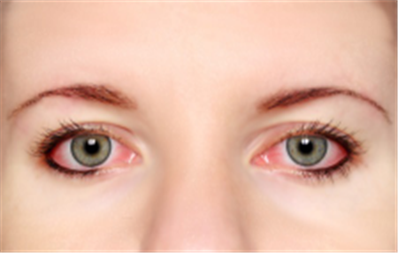 眼表眼角膜,?，斎鹨曆劭?上海眼科醫(yī)院