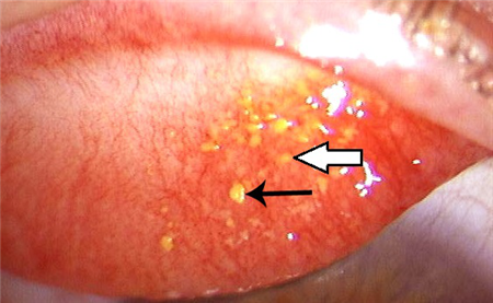 眼表眼角膜,希瑪瑞視眼科,上海眼科醫(yī)院