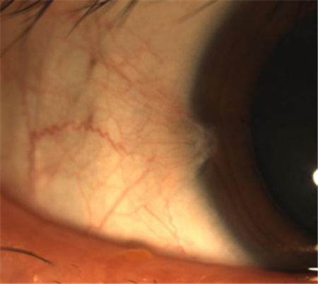 眼表眼角膜,?，斎鹨曆劭?上海眼科醫(yī)院