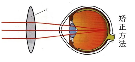 屈光矯視,?，斎鹨曆劭?上海眼科醫(yī)院