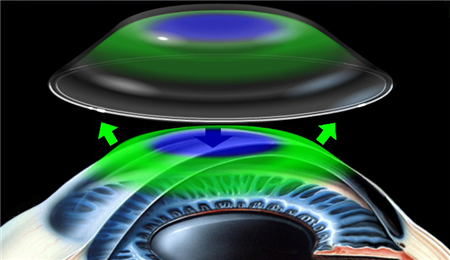 眼表眼角膜,?，斎鹨曆劭?上海眼科醫(yī)院