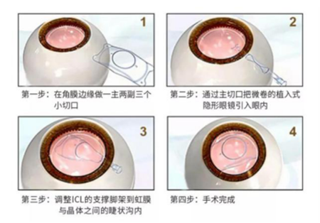 屈光矯視,?，斎鹨曆劭?上海眼科醫(yī)院