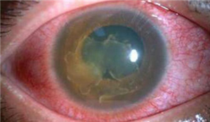 眼表眼角膜,希瑪瑞視眼科,上海眼科醫(yī)院