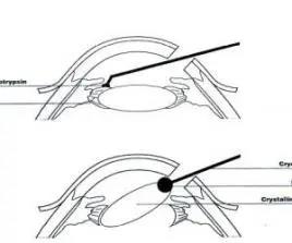 白內(nèi)障,?，斎鹨曆劭?上海眼科醫(yī)院
