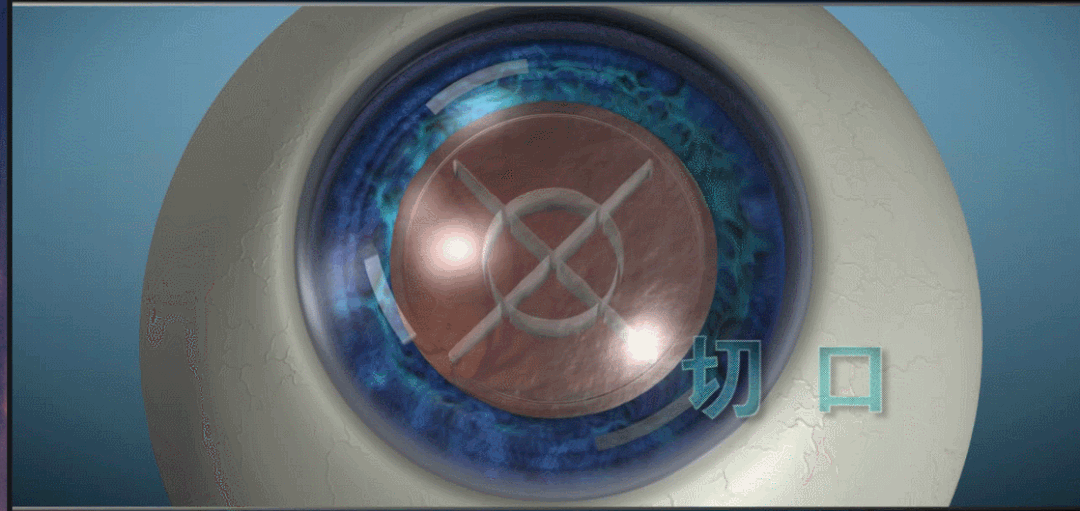 白內(nèi)障,?，斎鹨曆劭?上海眼科醫(yī)院