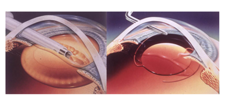 白內(nèi)障,?，斎鹨曆劭?上海眼科醫(yī)院