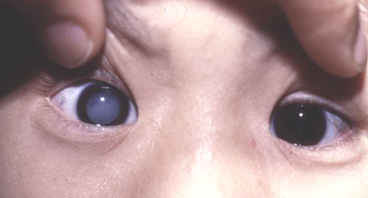 白內(nèi)障,?，斎鹨曆劭?上海眼科醫(yī)院