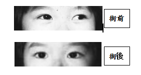 小兒眼病,?，斎鹨曆劭?上海眼科醫(yī)院