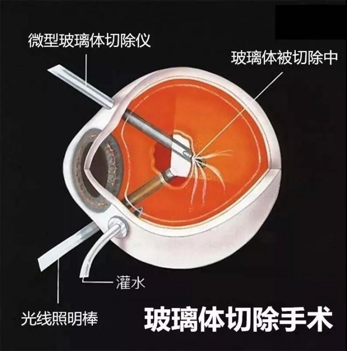 玻璃體視網(wǎng)膜,?，斎鹨曆劭?上海眼科醫(yī)院