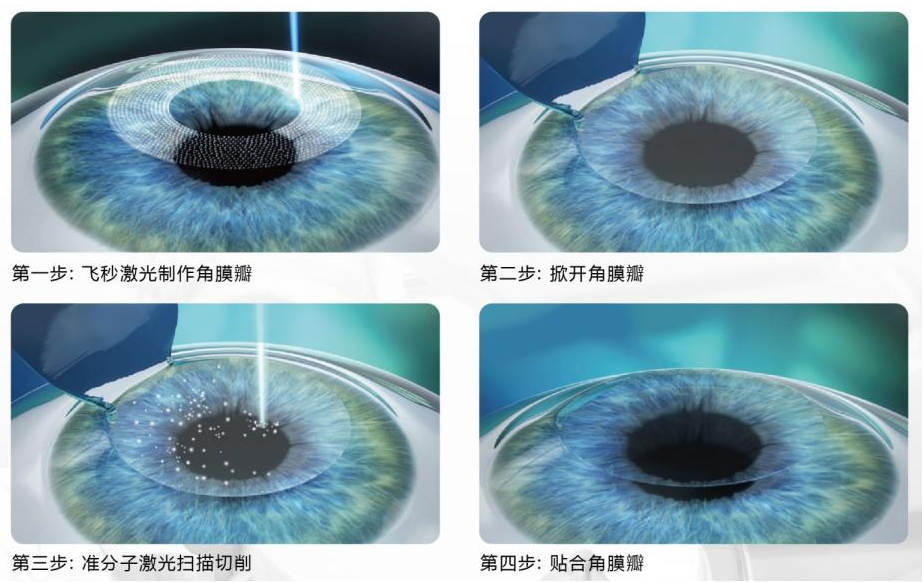 屈光矯視,?，斎鹨曆劭?上海眼科醫(yī)院