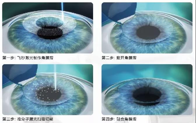 屈光矯視,?，斎鹨曆劭?上海眼科醫(yī)院