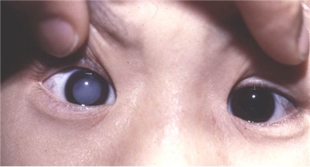 白內(nèi)障,?，斎鹨曆劭?上海眼科醫(yī)院