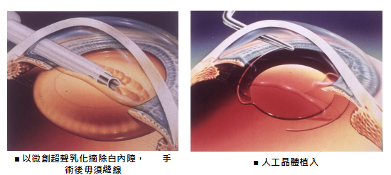 白內障,?，斎鹨曆劭?上海眼科醫(yī)院