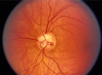 青光眼?？?/>
		</div>
		<div   id=